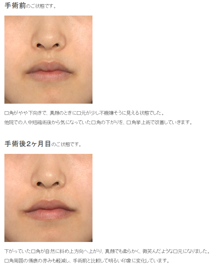 【口角挙上（スマイルリフト）症例】人中短縮後に気になる口角の下がりを改善｜20代女性・術後2ヶ月