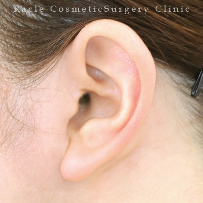 手術後12ヶ月目