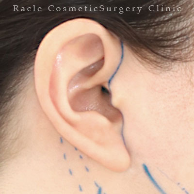 手術前デザイン