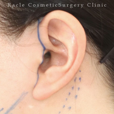 手術前デザイン