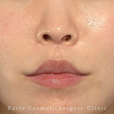 手術後12ヶ月目