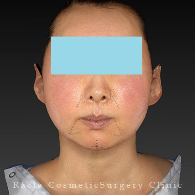 手術前デザイン