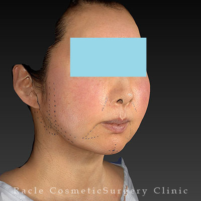 手術前デザイン