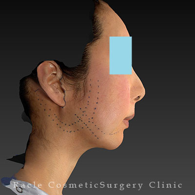 手術前デザイン