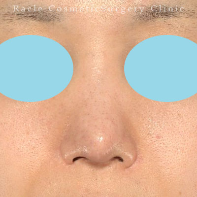 手術後12ヶ月目