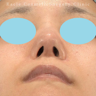 手術後12ヶ月目