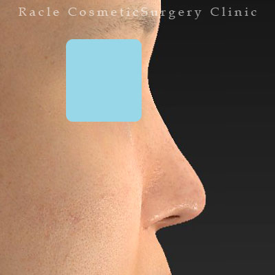 手術後12ヶ月目