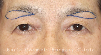 手術前デザイン