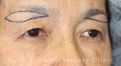 手術前デザイン