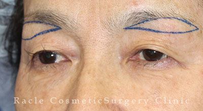 手術前デザイン