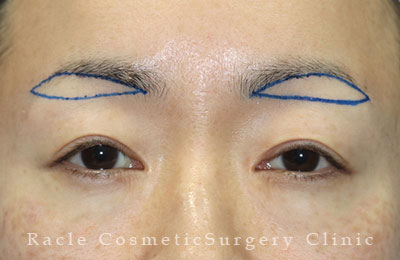 手術前デザイン