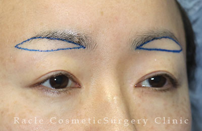 手術前デザイン