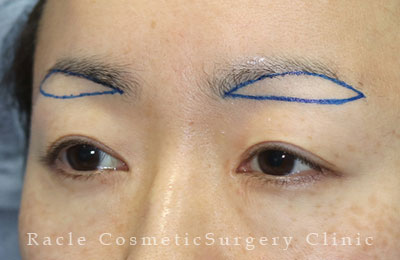 手術前デザイン