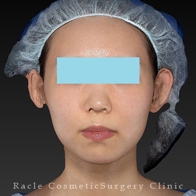 サーマクールFLX 600shot 顔＋首20代女性の症例写真 | 新宿ラクル美容