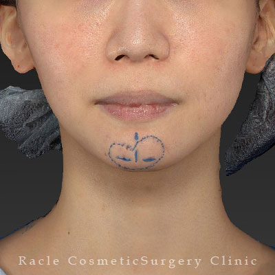 手術前デザイン