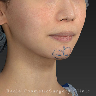 手術前デザイン