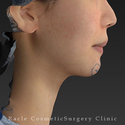 手術前デザイン