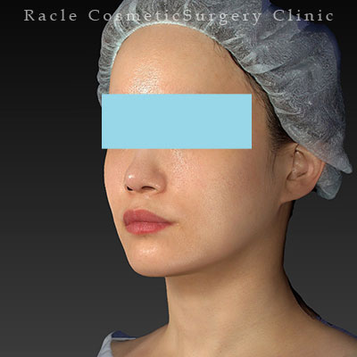 手術後12ヶ月目