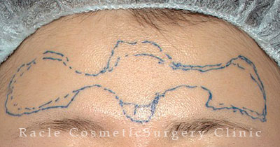 注入前デザイン