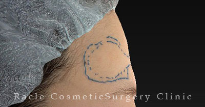 注入前デザイン