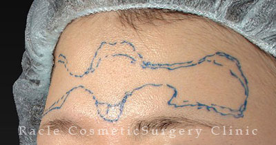 注入前デザイン