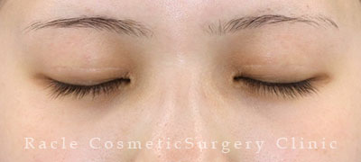 手術後12ヶ月目