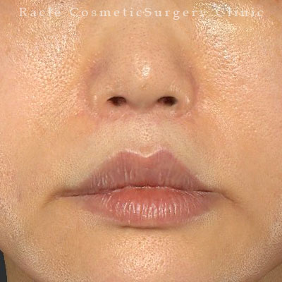 手術後12ヶ月目