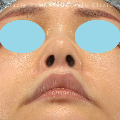 手術後12ヶ月目