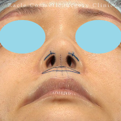 手術前デザイン