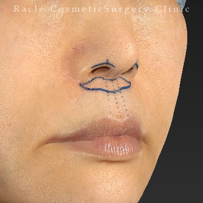 手術前デザイン