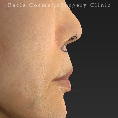 手術前デザイン