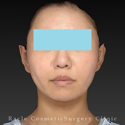 手術後12ヶ月目