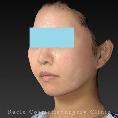 手術後12ヶ月目