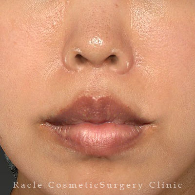 手術後12ヶ月目