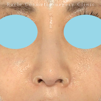 手術後12ヶ月目