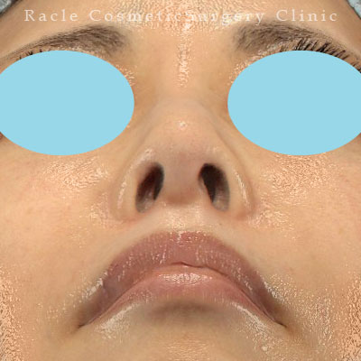 手術後12ヶ月目