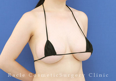 手術後12ヶ月目