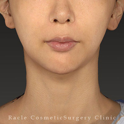 手術後12ヶ月目