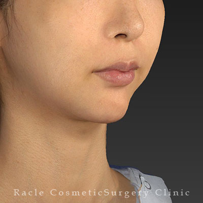 手術後12ヶ月目