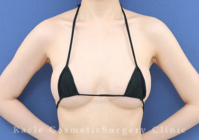 手術後12ヶ月目