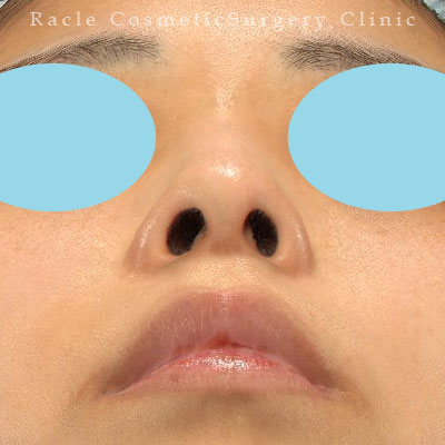 手術後12ヶ月目