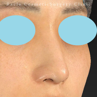 手術後12ヶ月目