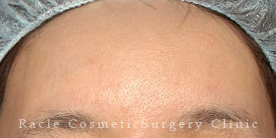 手術後12ヶ月目