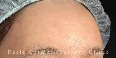 手術後12ヶ月目