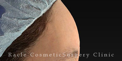 手術後12ヶ月目