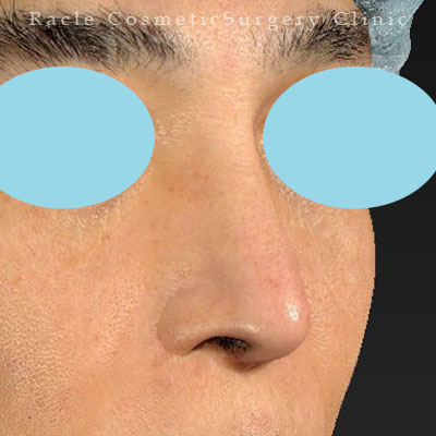 手術後12ヶ月目