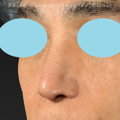 手術後12ヶ月目