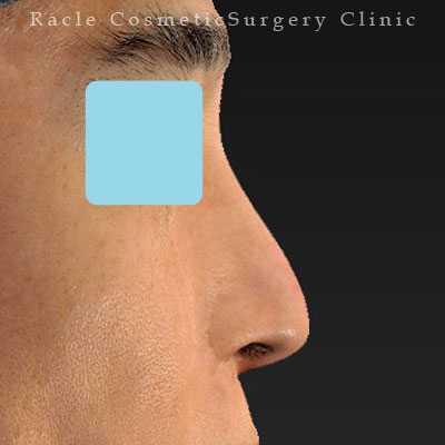 手術後12ヶ月目