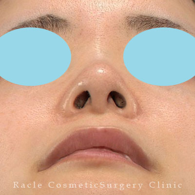 手術後12ヶ月目