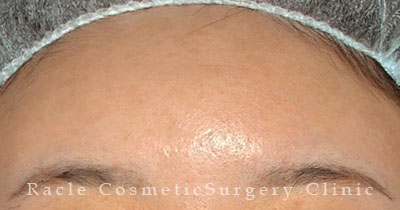 手術後12ヶ月目